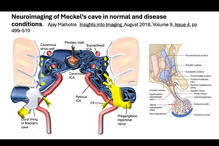 CAVERONOUS SINUS